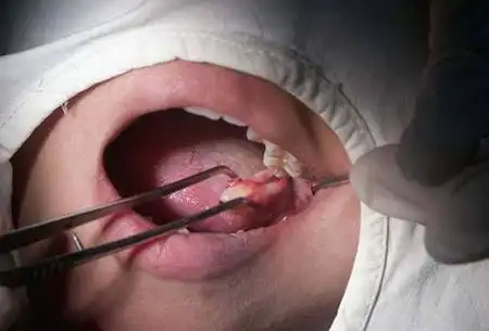 每当智齿冠周炎犯了,牙齿总会疼痛难忍,很多患者不清楚该如何治疗,总