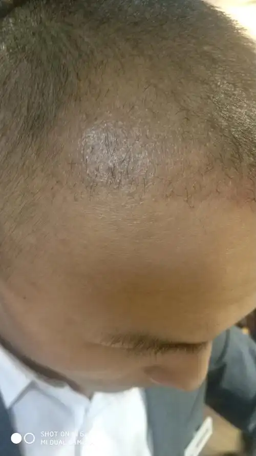 这几天发际线种植区的毛囊开始脱落了,捉急啊