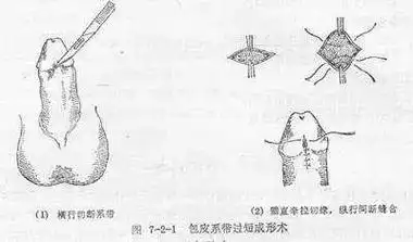 包皮手术后系带短怎么补救