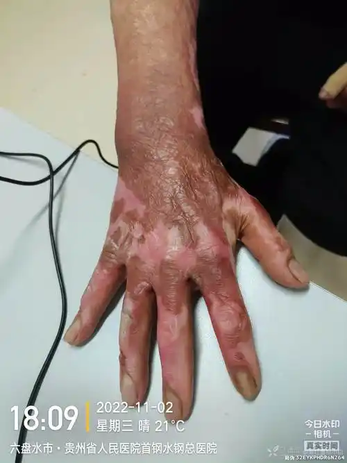 烧伤手部瘢痕挛缩治疗方案探讨中