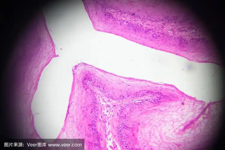 显微镜下呈层状鳞状上皮