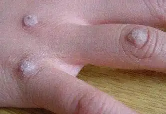 我不敢肯定芝麻花能治好所有的刺瘊子,我和同事都