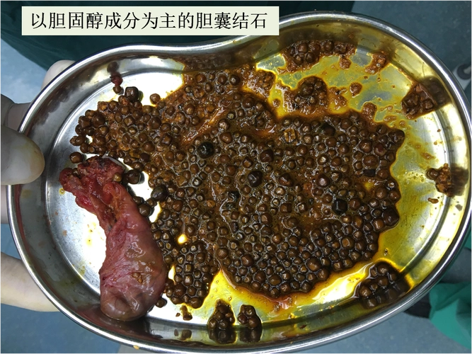 胆囊结石_发病原因_如何预防 - 好大夫在线