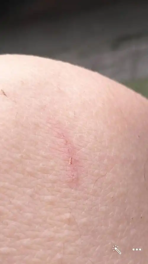 请问被自己狗狗爪子刮伤了个小口,需要去医院打一针狂犬疫苗吗?