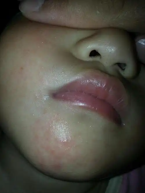 一岁半宝宝,这是过敏吗?去医院能查处过敏源吗?