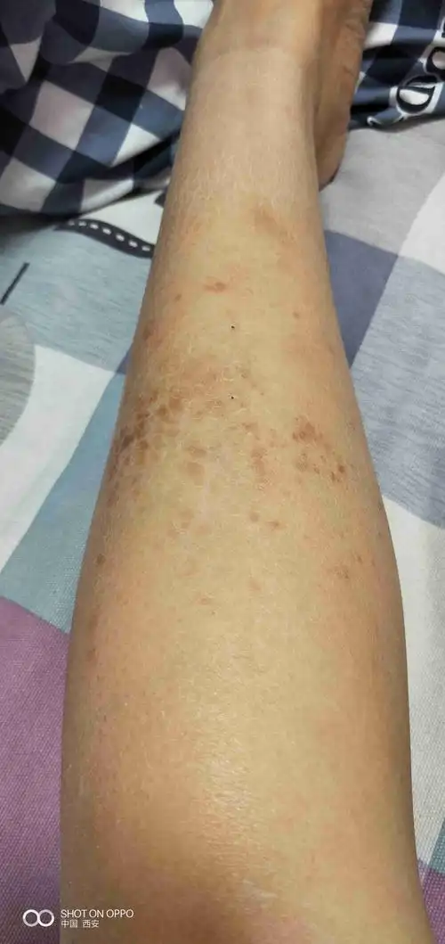 几年前左小腿上长了一点褐色的斑点,不疼不痒的,夏天就少了,最近睡觉