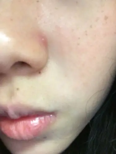 鼻翼处长了一个砣～好大好大都不消.