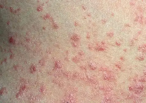 小的,点状的红色斑块:手臂腿头皮躯体点滴状银屑病是第二常见的牛皮癣