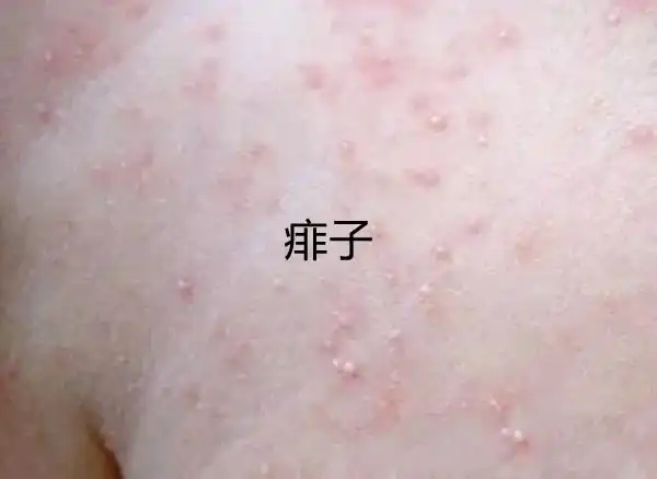 2,湿疹,慢性病症,引起湿疹的原因有很多.