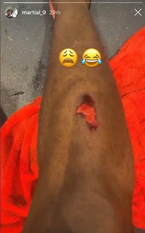 马夏尔赛后晒出受伤的腿