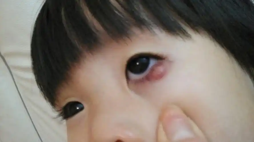 孩子霰粒肿,病情如图.