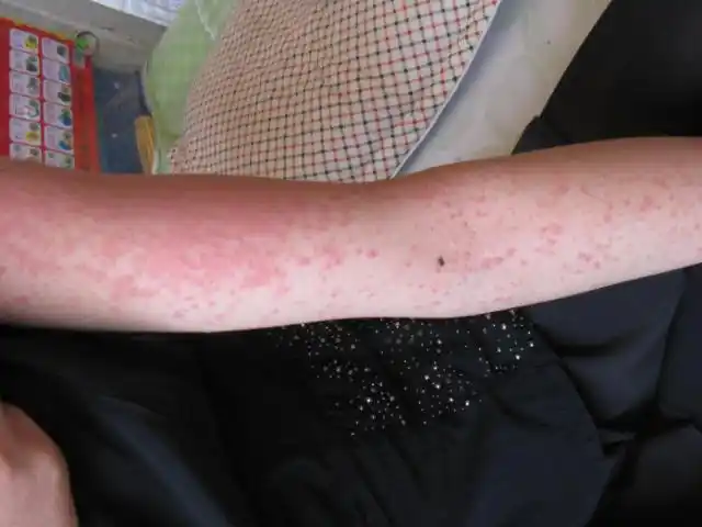 白血病会伴有大面积红色皮疹