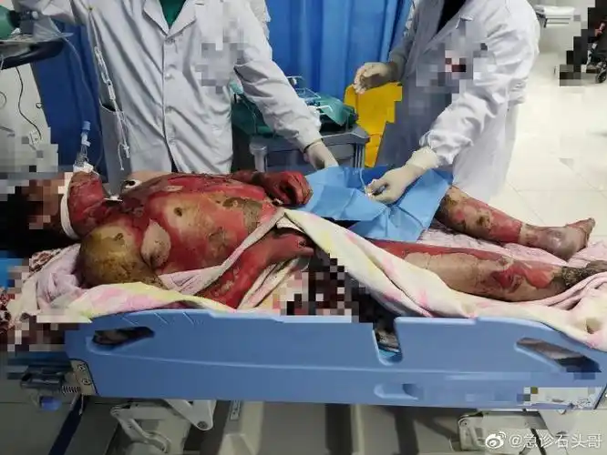 医学科普##烫伤##烧伤##snh48唐安琪意外烧伤##吃烧烤全身烧伤