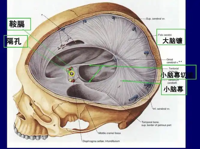 鞍膈 隔孔 大脑镰 小脑幕切迹 小脑幕