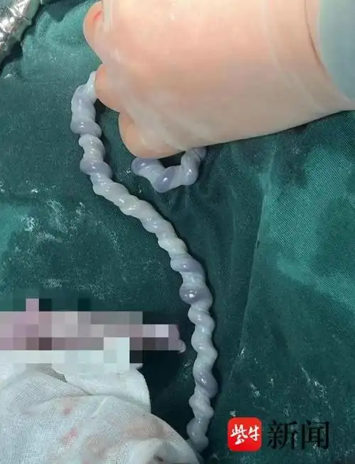 脐带扭转54圈成麻花医生真没见过