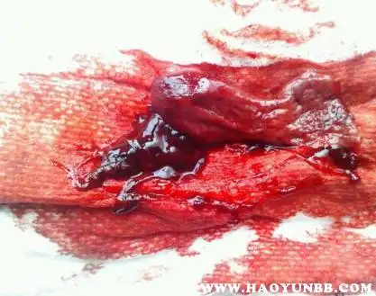 人流后排出的恶露什么样子,图片