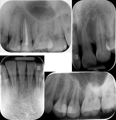 根尖片医疗辐射是人类接触电离辐射的最主要来源,x线,ct,放射治疗都会