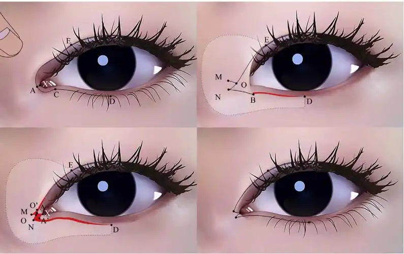 开内眼角的那些事儿