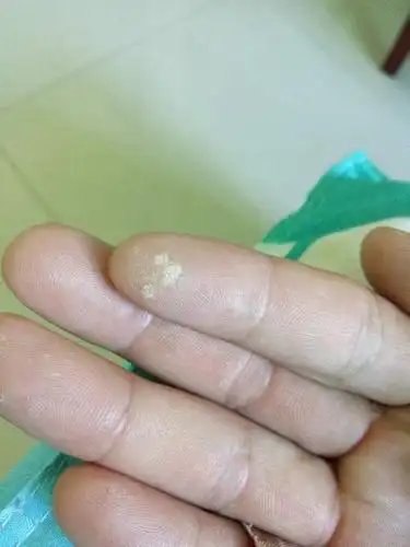 请问我手指上长的是什么东西 发白 平时有点硬 刚开始就一个 后来周围