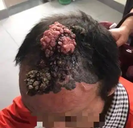 身上总能摸到疙瘩和脓包?或暗示4种疾病,别不当回事