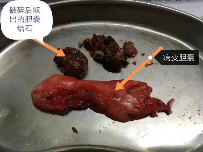 腹腔镜胆囊切除病例展