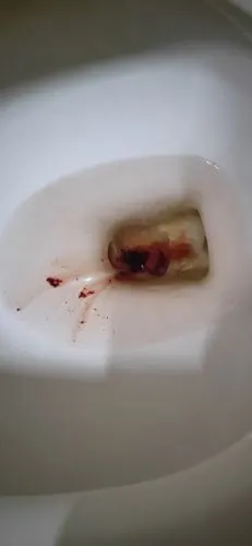 有没有打了黄体酮针吃了保胎药还流血的孕妈?