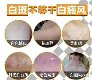 大夫,您看我们家孩子脸上这"白斑"是白癜风吗? - 知乎