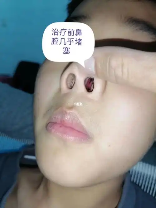 慢性鼻炎  #过敏性鼻炎慢性鼻炎鼻窦炎鼻息肉