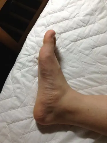 我这样的扁平足算严重的吗?可以治好吗?