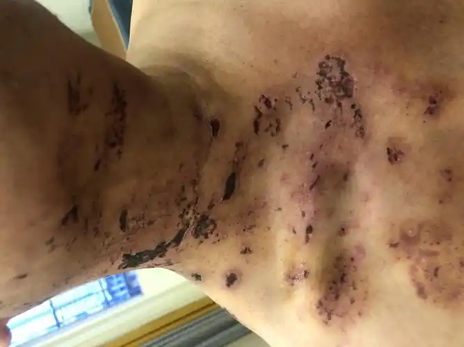 带状疱疹中医治疗