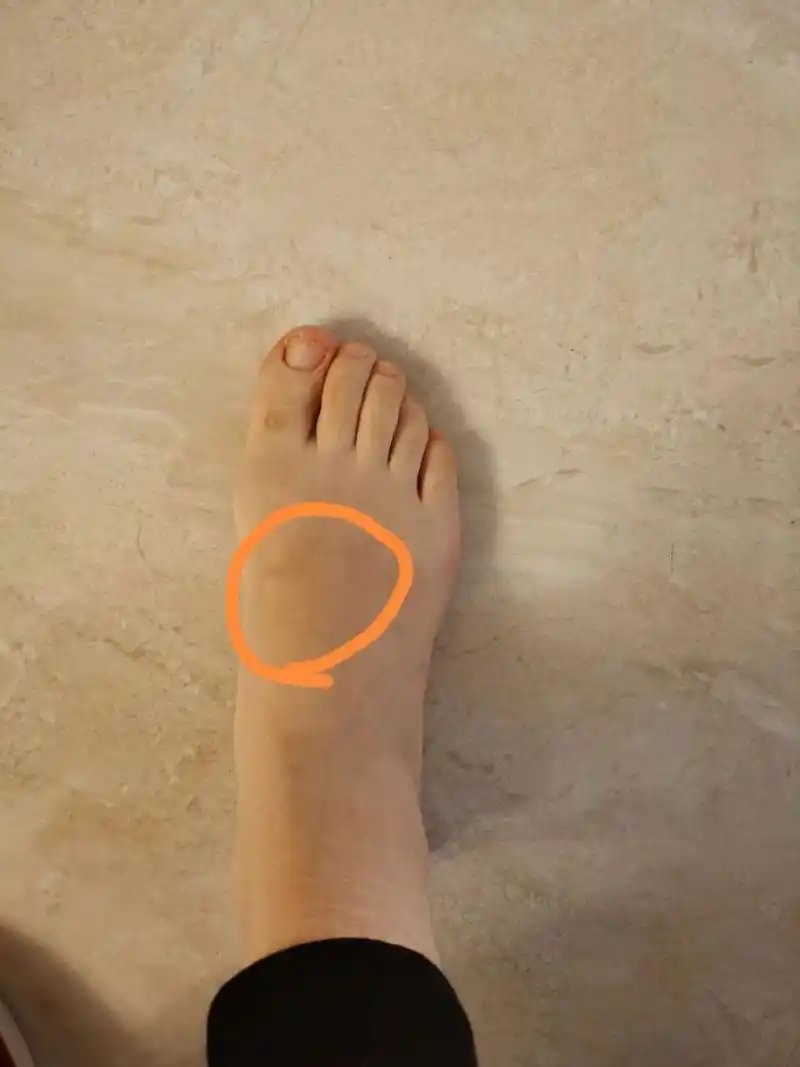 脚背疼 脚背画圈的地方疼,总是莫名其妙的疼,日常穿鞋子也是运动鞋