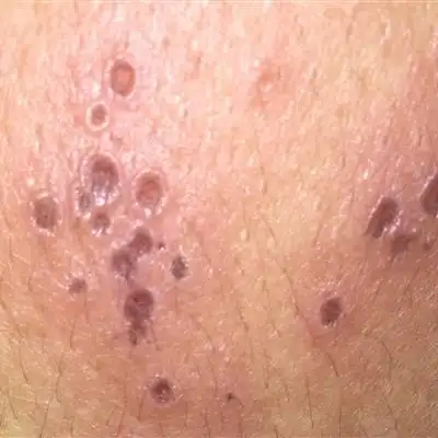 3第三:阴茎珍珠状丘疹多见于20-30岁左右的男性.