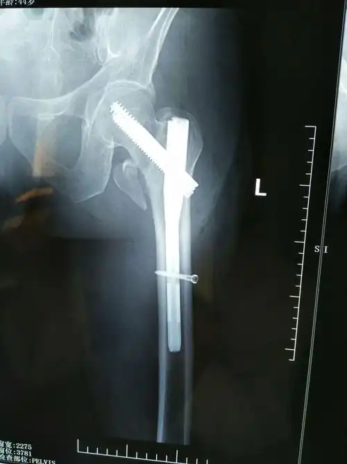 intertan髓内钉内固定病例分享(尧都区人民医院骨三科高峰)