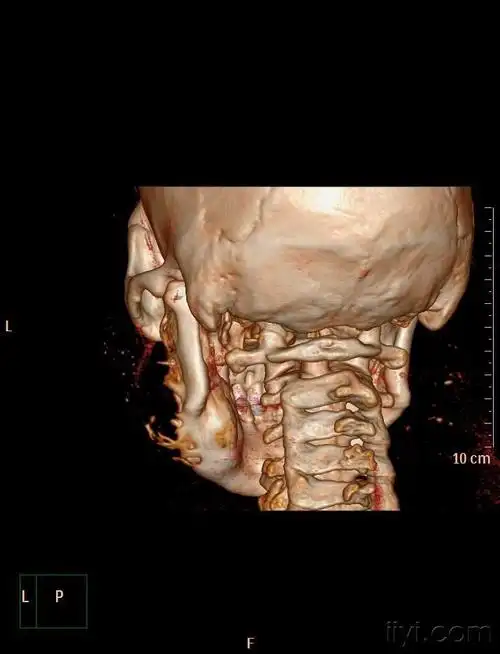 下颌骨病例有病理病理结果造釉细胞瘤