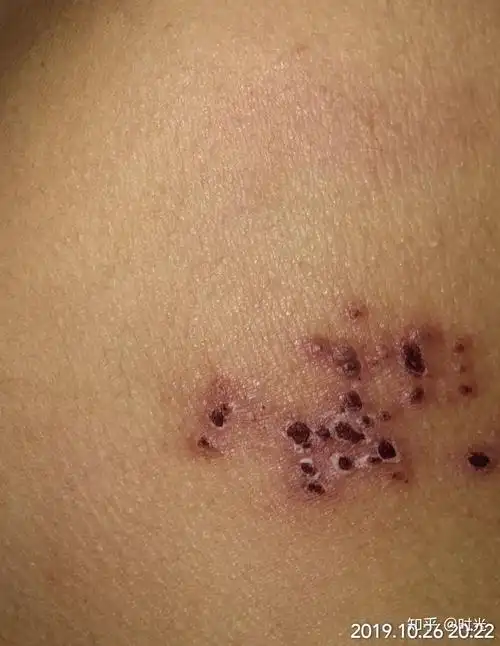 有哪些密集恐惧症的人看了会头皮发麻的图片