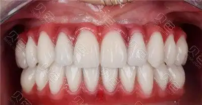 过一颗,两颗或者是多颗种植体,但是全口牙齿掉光是不是要种满20多颗?