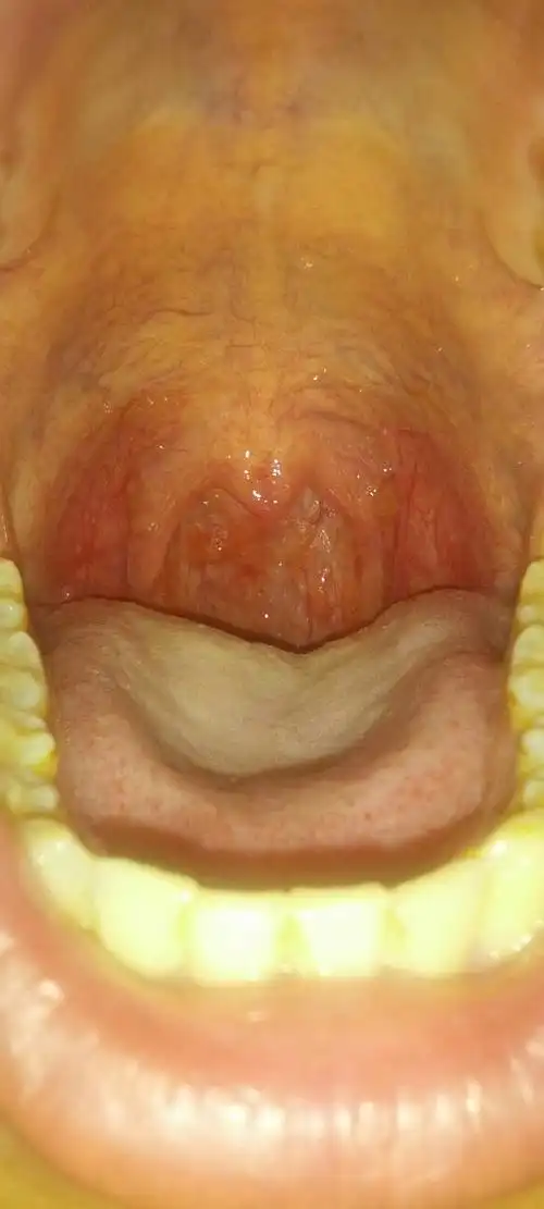 嗓子很红,里面还有小点,吃了不少药,没有效果,不