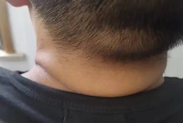 后脑勺一堆赘肉挂着,一抬头整个后脖颈的肉挤出好几条横纹,十分丑陋显