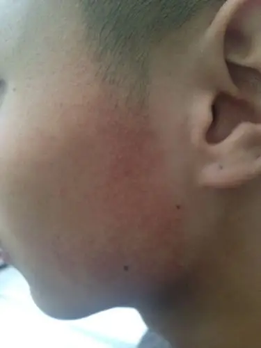 面部两侧皮肤呈暗红色,皮肤很粗糙,还有凸出的白色颗粒,有图片,已经