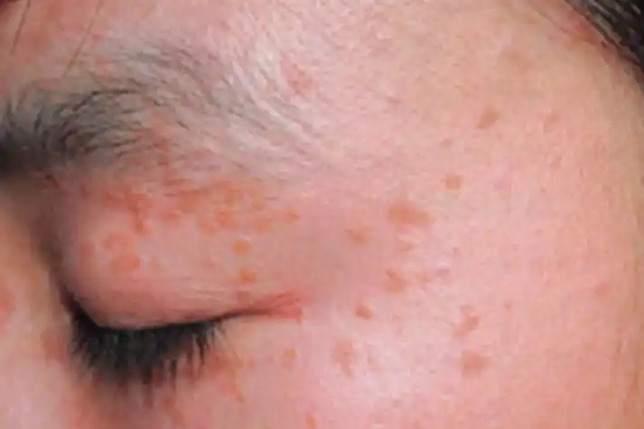 人乳头瘤病毒早期图片