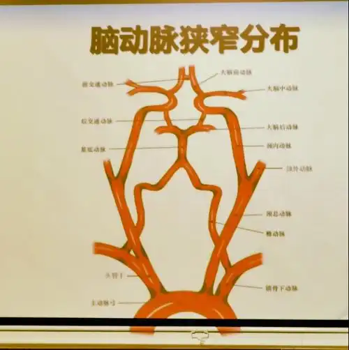 脑动脉易出现血管狭窄的部位.