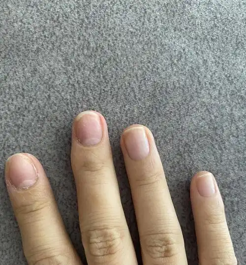 痛苦的4年甲营养不良患者本人