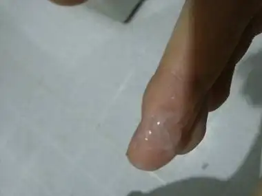 医生提醒:当hpv发展为宫颈癌时,白带会有这种变化,注意观察