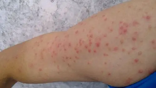 艾滋病红斑图片 (59)_有来医生