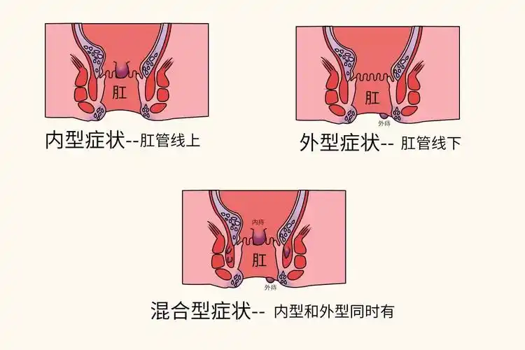 女性痔疮图片什么样子