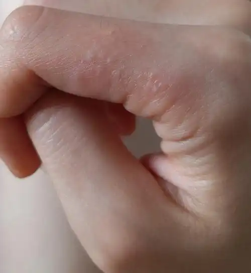 手指上的水泡是啥啊姐妹们你们手上有吗