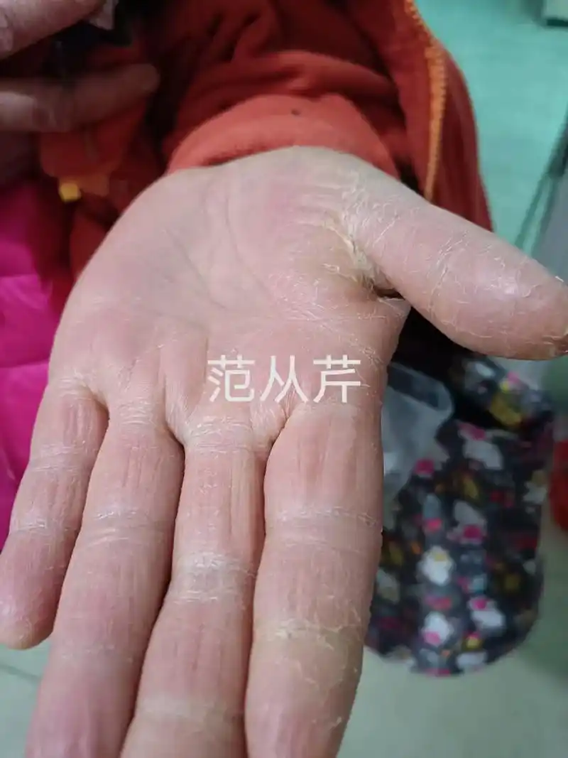 美女灰指甲手癣干裂25年,我帮她治好,特别相信我,又纹眉后心 - 抖音