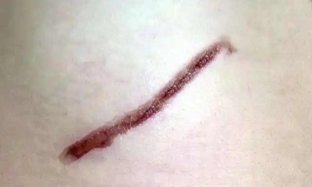 一女子因腹部有伤疤,未婚夫得知真相后,解除婚约并要回彩礼