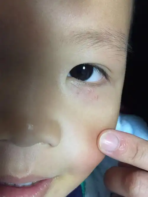 5岁宝宝下眼皮表面长红疙瘩,不痒