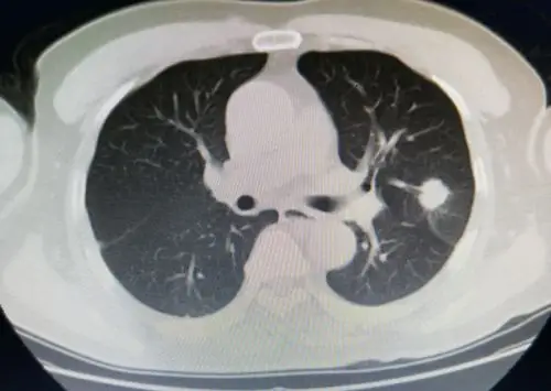 左上肺叶实性结节,不规则,可见毛刺,根据临床经验考虑为肺癌可能性大.